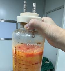 沧县水动力吸脂手术要做多久？